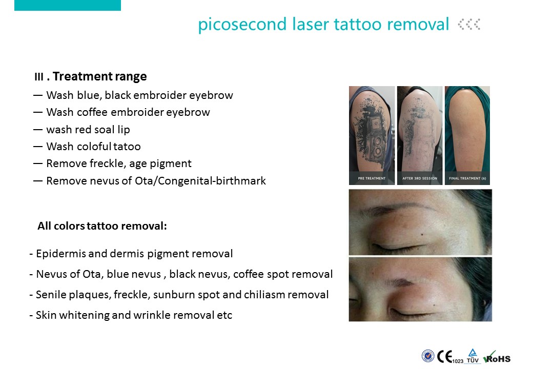 Tattoo Removal Machine