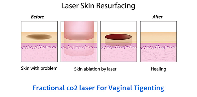 Co2 Fractional Laser Machine