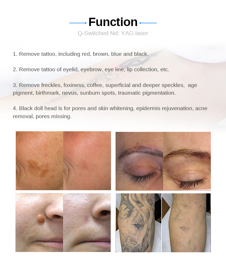 Tattoo Removal Laser Equipment