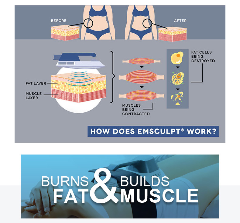 Electromagnetic Muscle Stimulation