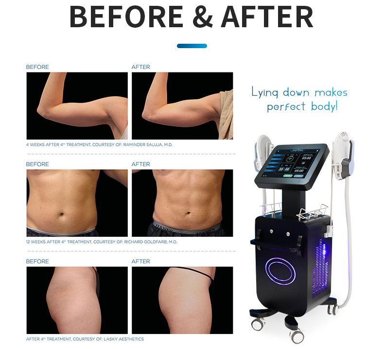 High-Intensity Electromagnetic Muscle Stimulation