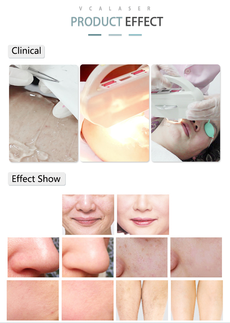 Dpl Hair Removal