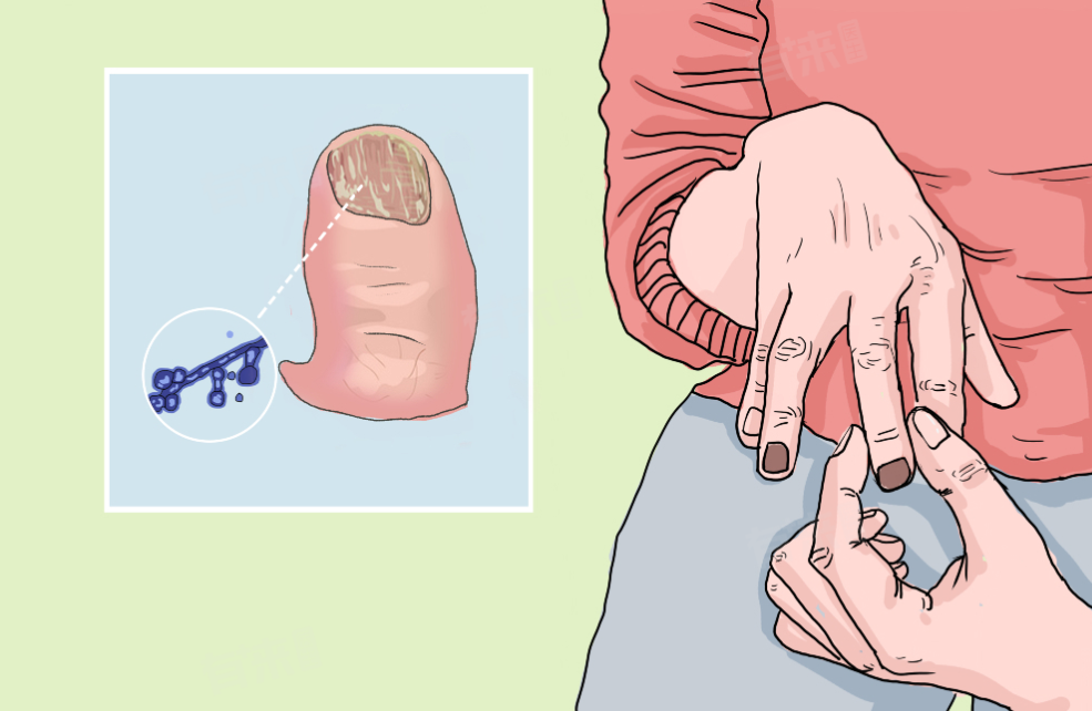 What is Ciclopirox Used For