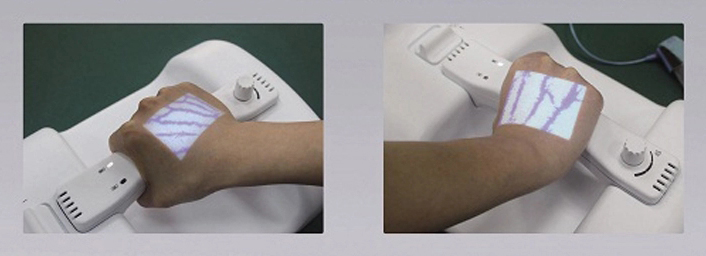 portable infrared vein viewer portable infrared vein viewer