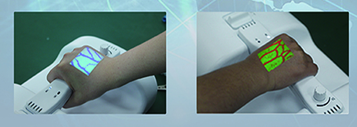 Venous Transfusion Assistant Vein Finder Venous Transfusion Assistant Vein Finder