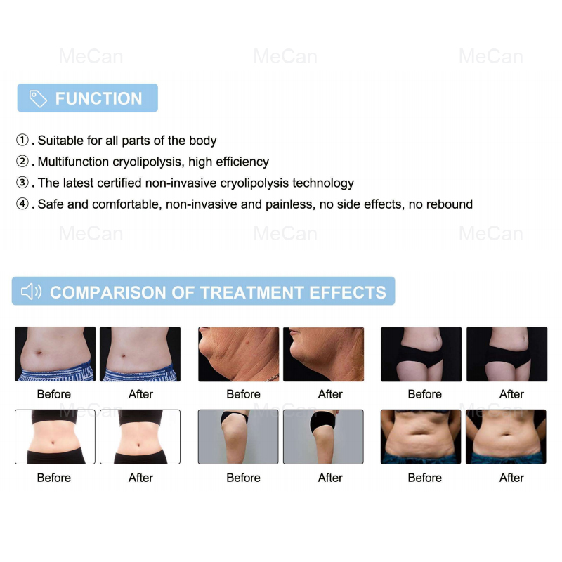 Factory Price Non-surgical Vertical 360° Criolipolisis Weightloss Machine 10