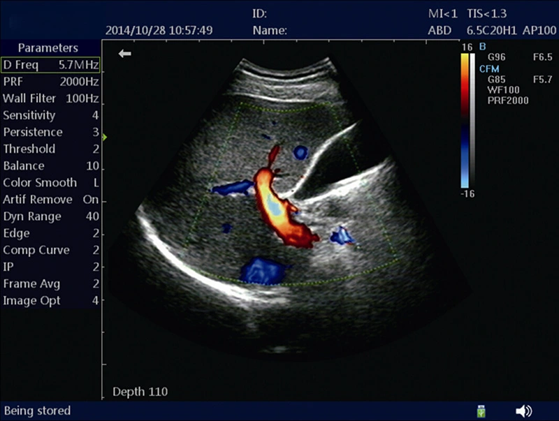 Full Digital Portable Color Doppler Ultrasound Scanner 6