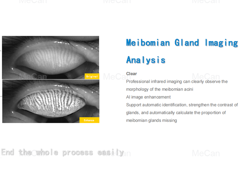 Medical Dry Eye Examination Meibography Infrared Dry Eye Ocular Surface Analyzer 11