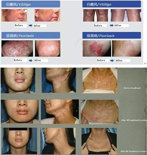 311nm Narrowband UVB Lamp Psoriasis Vitiligo 8