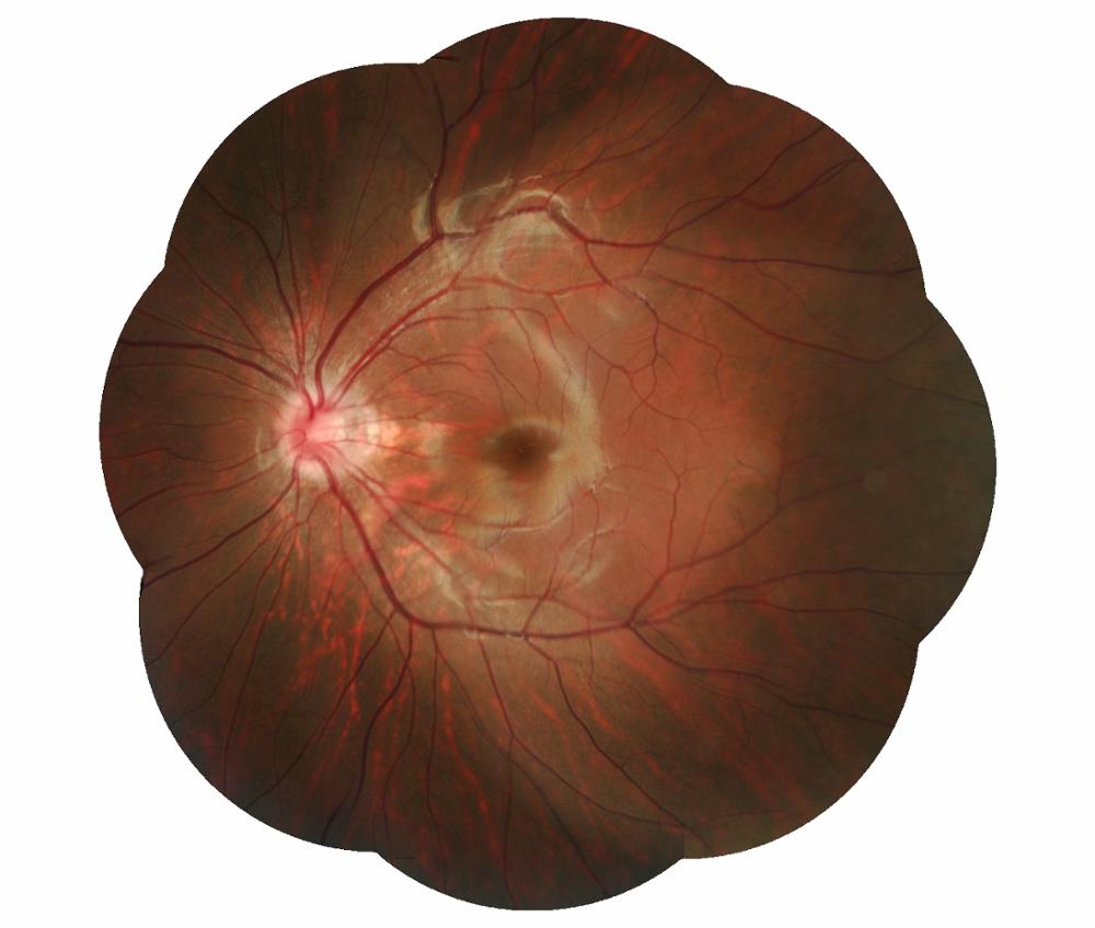 Non-mydriatic Eye Digital Fundus Camera Non-mydriatic Eye Digital Fundus Camera
