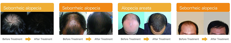 Low Level Laser Helmet Hair Loss Laser Therapy Treatment Machine 7