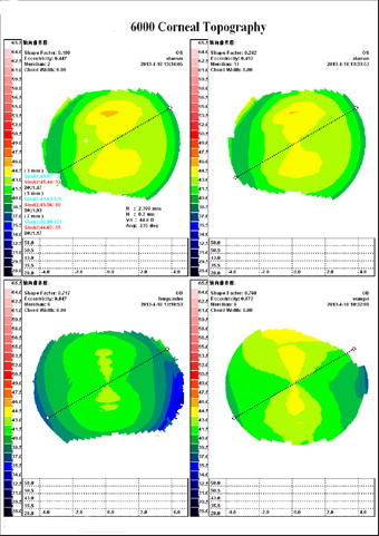 Eye Test Corneal Topographer Eye Test Corneal Topographer