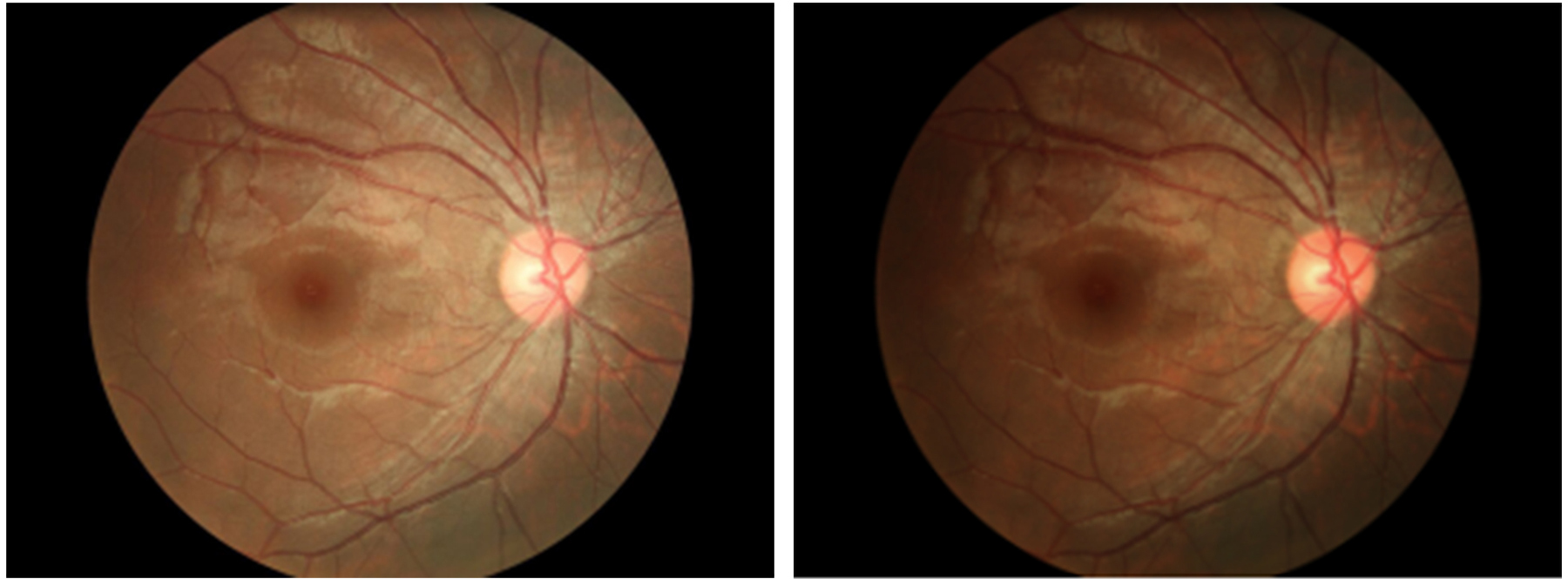digital fundus camera digital fundus camera