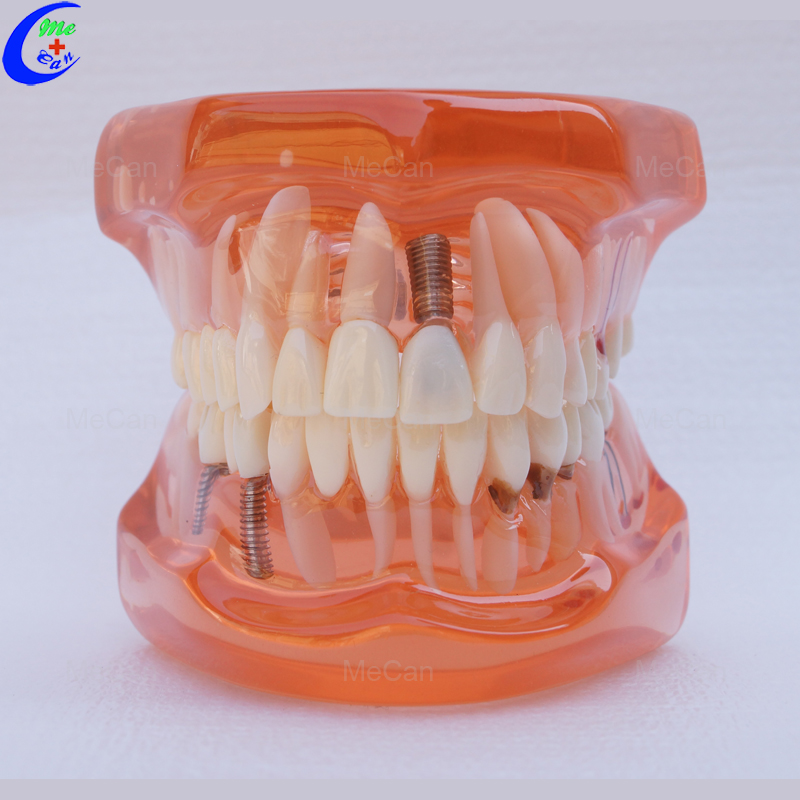 Plastic Dental Model of Teeth, Restoration with Implant Plastic Dental Model of Teeth, Restoration with Implant