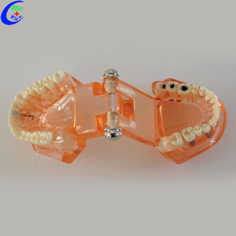 Plastic Dental Model of Teeth, Restoration with Implant Plastic Dental Model of Teeth, Restoration with Implant