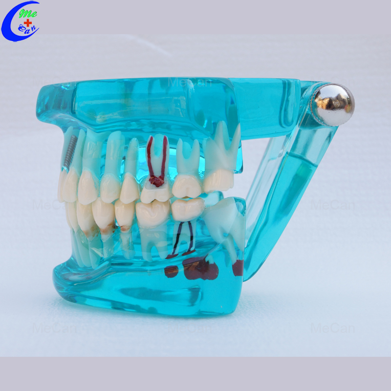 Plastic Dental Model of Teeth, Restoration with Implant Plastic Dental Model of Teeth, Restoration with Implant