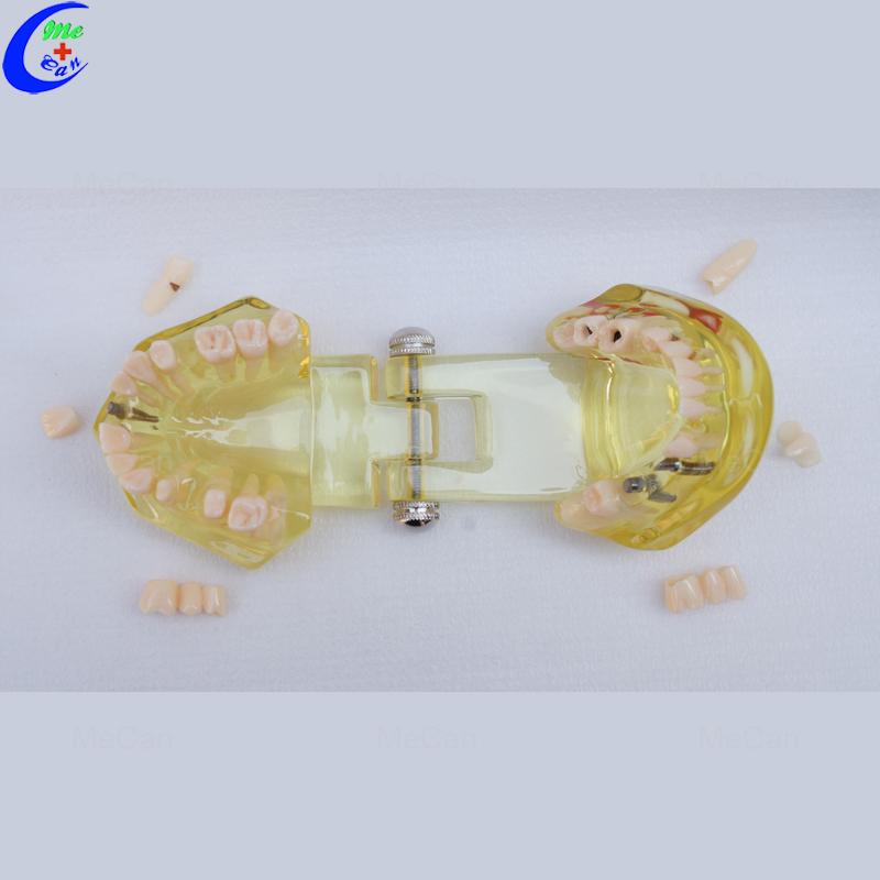 Plastic Dental Model of Teeth, Restoration with Implant Plastic Dental Model of Teeth, Restoration with Implant