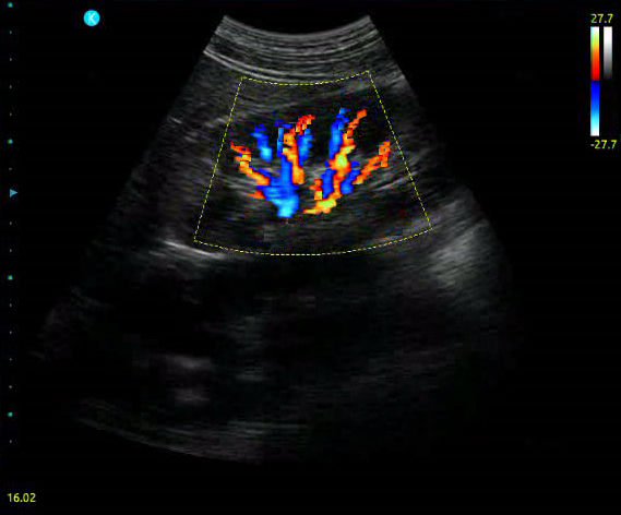 Color Doppler Color Doppler