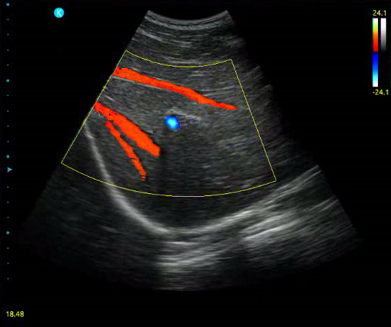 Color Doppler Color Doppler