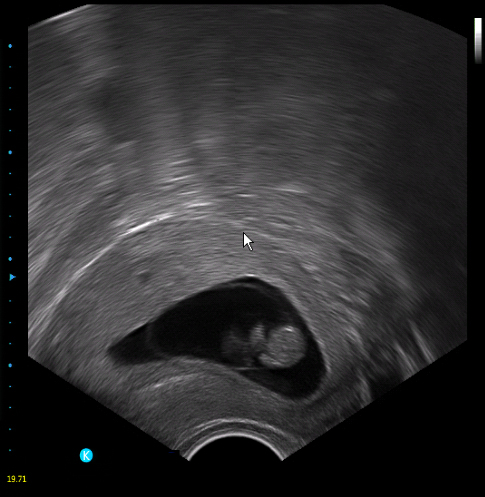 Portable Color Doppler Ultrasound Scanner Portable Color Doppler Ultrasound Scanner
