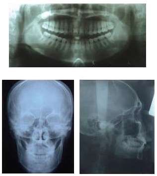 Opg dental x-ray Opg dental x-ray