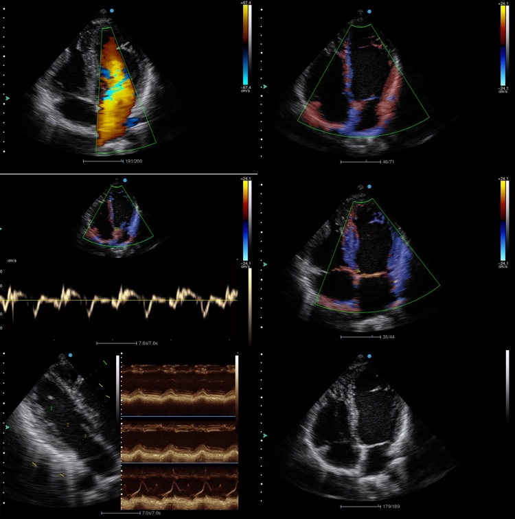 Cardiac 2D 3D Portable Echocardiography Machine Ultrasound 10