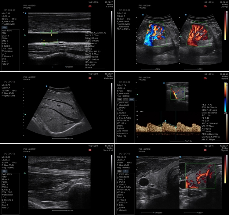 Cardiac 2D 3D Portable Echocardiography Machine Ultrasound 11
