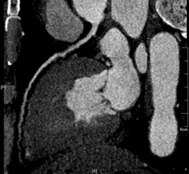 Lesion detection