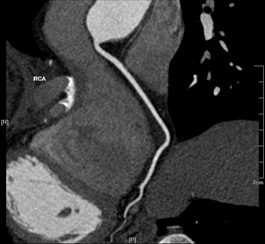 Lesion detection