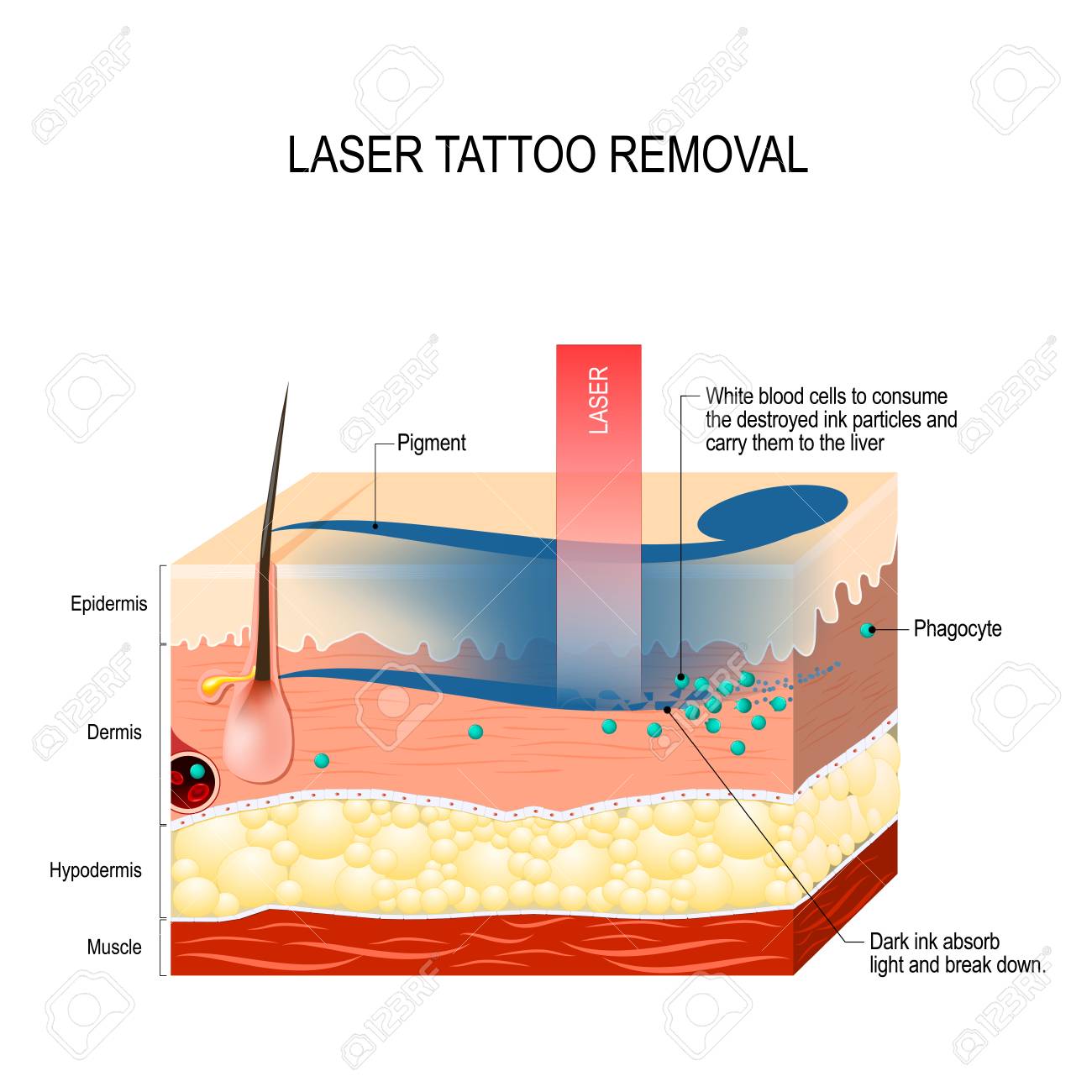 q Switch laser machne (2).jpg