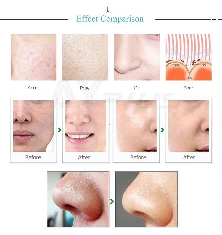 AYJ-X13B (CE)2018 New Beauty Device Best RF Skin Tightening Face Lifting Machine.jpg