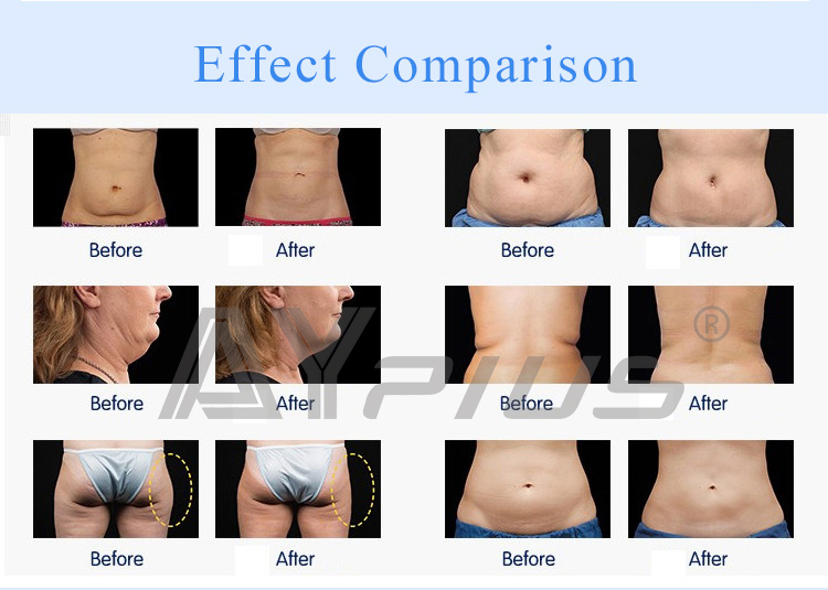 AYJ-AY19(CE) lymphatic drainage body slimming rf cavitation slimming machine.jpg