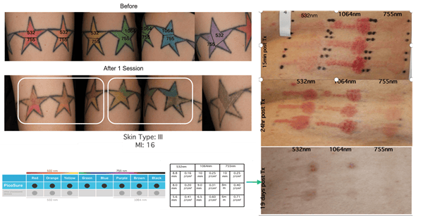 Tattoo Removal Laser Machine - Product Usage Results (Image 3)