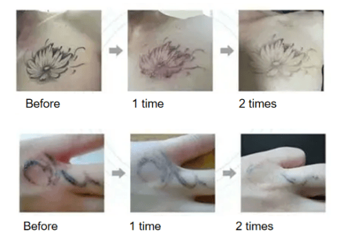 Tattoo Removal Pico Laser product effectiveness demonstration image 1