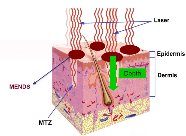 what is fractional laser​
