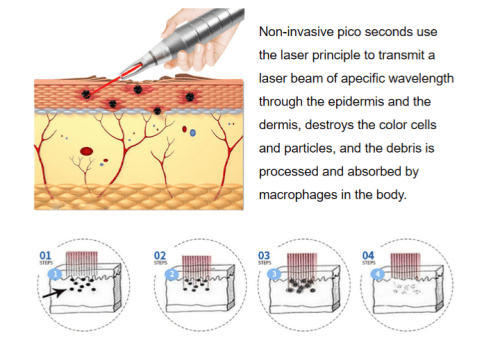 Tattoo Removal Pico Laser Product Features - Image 1