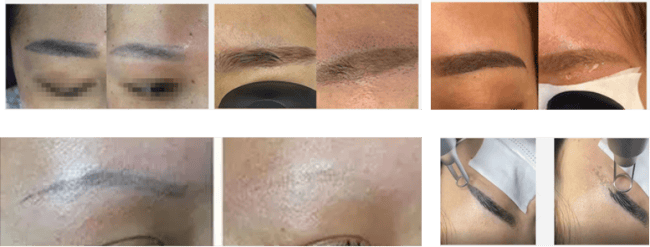 Tattoo Removal Pico Laser product effectiveness demonstration image 2