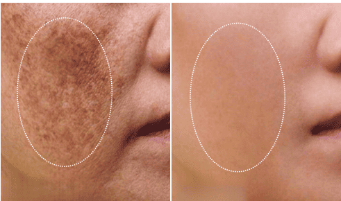 1550nm and 1927nm Dual-wavelength Fractional Laser Product Usage Effect Demonstration Image 2
