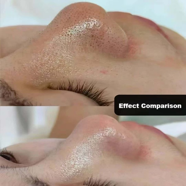 blackhead scraper