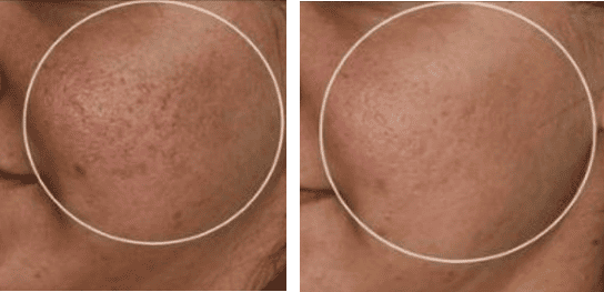 1550nm and 1927nm Dual-wavelength Fractional Laser Product Usage Effect Demonstration Image 5