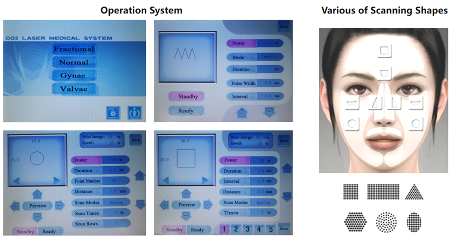 CO2 Laser Resurfacing Machine - Product Features Screen Display