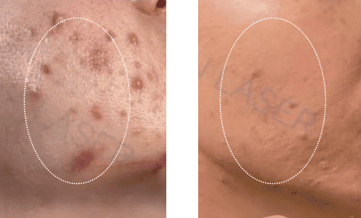 1550nm and 1927nm Dual-wavelength Fractional Laser Product Usage Effect Demonstration Image 4