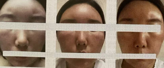 co2 fractional laser recovery