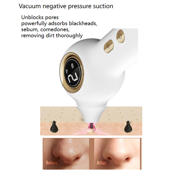 blackhead remover vacuum
