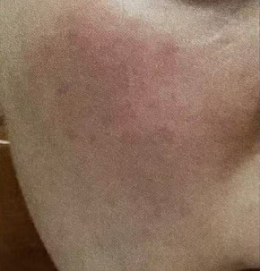 co2 fractional laser recovery