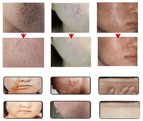 CO2 Laser Resurfacing Machine - Product Usage and Results Demonstration Images