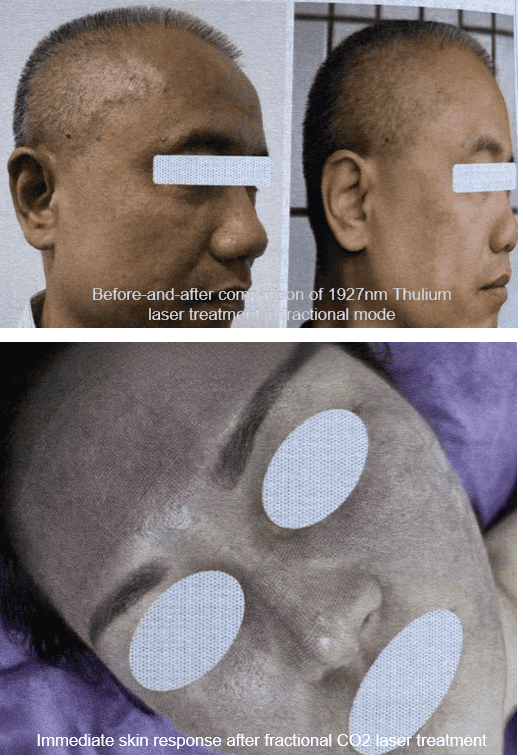what is fractional laser​