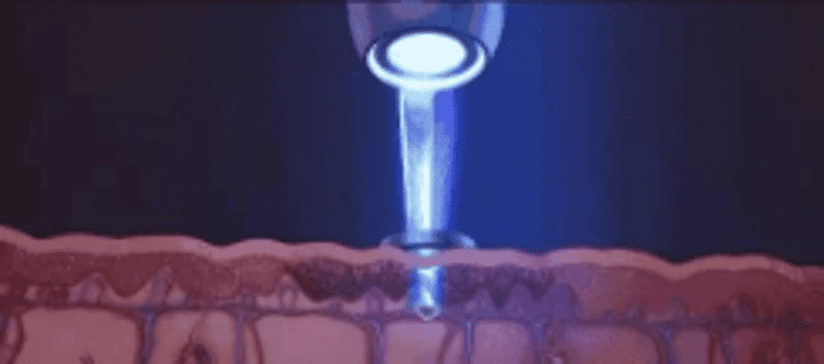laser tattoo removal machine Photoacoustic Effect