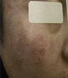 co2 fractional laser recovery