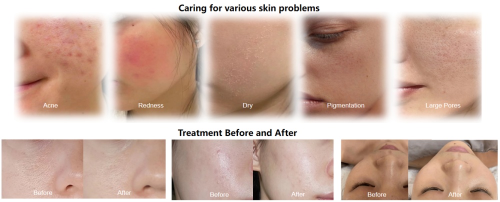 PDT LED light therapy machine: Comparison of treatment results (image)